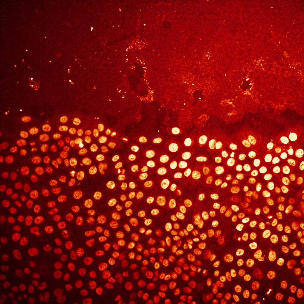 Syöpäsolujen tumat näkyvät samanvärisinä, kellertävinä pisteinä punaisella taustalla.